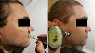 Sensory function in the faces of patients with facial palsy: A prospective observational study using quantitative sensory testing